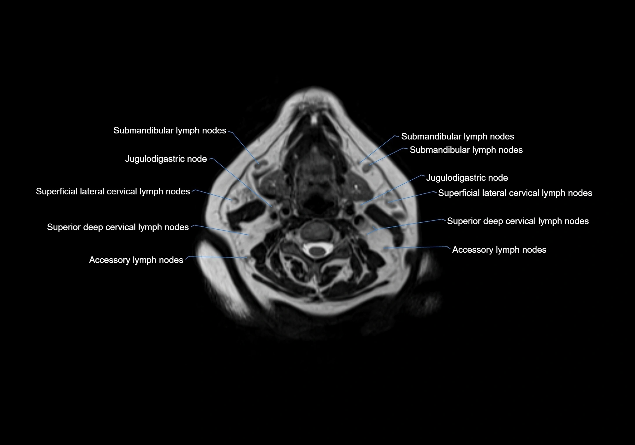 Neck axial  lymph node cross sectional MRI anatomy 3T MRI  image-img-00001-00053.webp